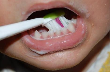 der Außen- und Innenflächen, wird die Zahnbürste in einem spitzen Winkel am Zahnfleischrand angesetzt und mit leichten