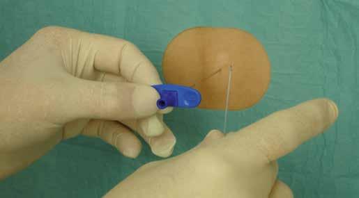 Im Gegensatz zur Spinalanästhesie wird durch die Punktionsnadel in den Periduralraum ein Katheter eingeführt, durch den ein Anästhetikum eingespritzt wird.