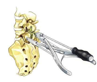 Durch die tiefe Insertion in die Facettengelenksebene wirkt das coflex-f + Implantat den auf die posteriore Säule wirkenden Kräften entgegen (interlaminäre Abstützung).