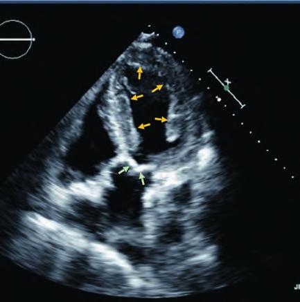 Abb. 2: Zweidimensionale Echokardiographie in der Diastole (wenn die Herzkammer entspannt ist). Bei einem 85-jährigen Patienten mit kardialer ATTR-Amyloidose.