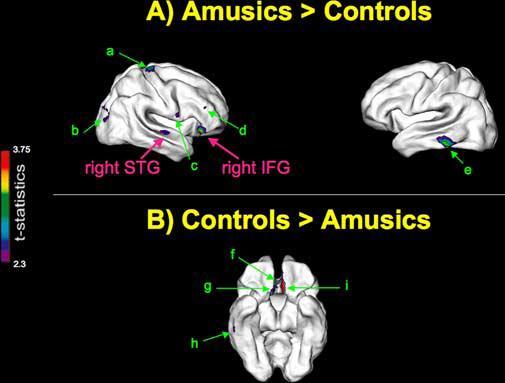 Cortical Thickness Hyde et al.