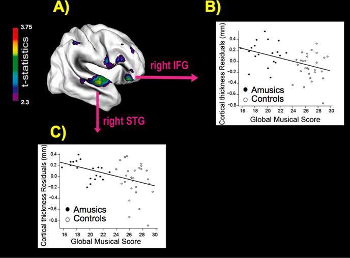 Cortical Thickness Negative Korrelation: Dicke