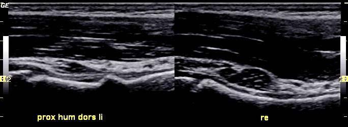 proximal humerus fractures were detected.