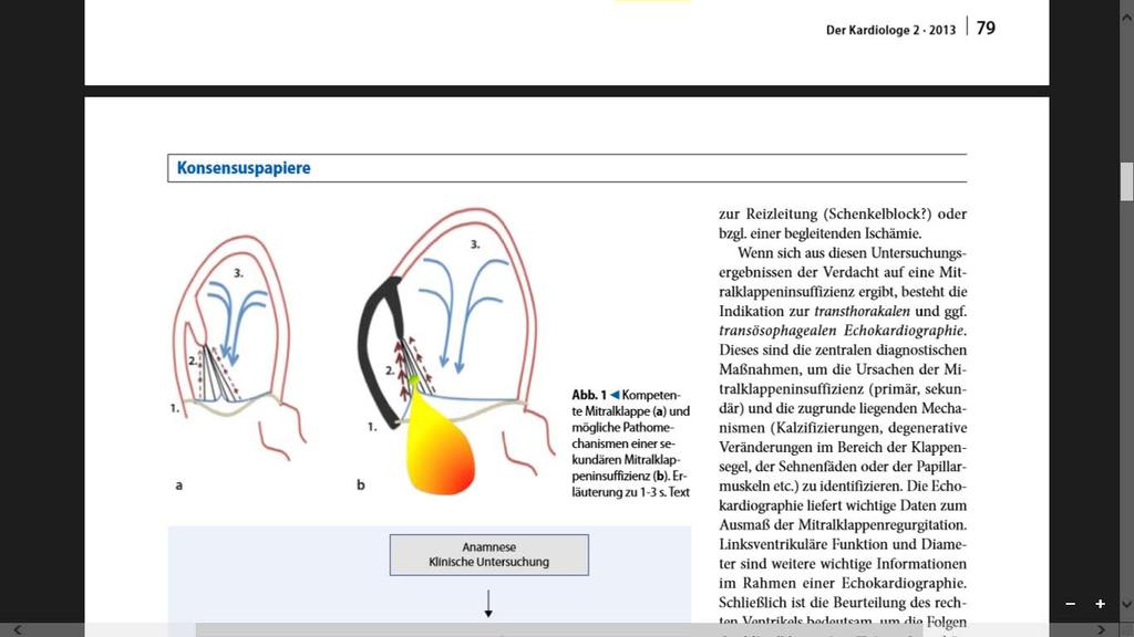 Pathophysiologie der sekundären Mitralinsuffizienz 8 Sekundäre/funktionelle Mitralinsuffizienz MINS resultiert aus