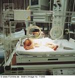 Bei Frühgeborenen ist sie deutlich häufiger anzutreffen als bei "Normalgeburten" und oft angeboren. Unter anderem deshalb gehören Frühgeborene in regelmässige augenärztliche Kontrollen.