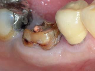 Verzögerte Sofortimplantation Dr. Leventis Status der bukkalen Lamelle Periimplantäre Lücke Zahn 46 Nachuntersuchung Defekt mit intakter bukkaler Lamelle > 1,5 mm 3 Monate Zahnarzt: Dr.