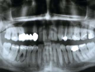 Verzögerte Sofortimplantation Dr. Hollay Status der bukkalen Lamelle Periimplantäre Lücke Zahn 46 Nachuntersuchung Apikale Knochenzyste > 1,5 mm 5 Jahre Zahnarzt: Dr.