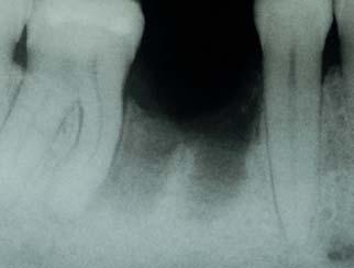 Verwendetes Material: GUIDOR easy-graft CLASSIC; Dentalimplantat: Astra Tech.