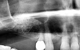 Sinuslift Applikationsinstrument nach der OP