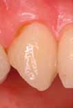 G-Coat PLUS verhindert die Anfangsempfindlichkeit gegenüber Wasser und schützt den Zahn und die Restaurationsränder vor Randundichtheiten und Verfärbungen.