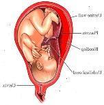 Vorzeitige Plazentalösung Definition: = Blutung zwischen Plazenta und Uterusinnenwand.