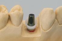 3a 3b 3c Wichtig: Vor der Abgabe der Arbeit an den Zahnarzt muss der seitliche und der okklusale Verschluss der Schraubenöffnungen wieder restlos entfernt und das Sekundärteil gereinigt werden. 3. Anschliessend erfolgt die Modellation und der Guss des Gerüsts.