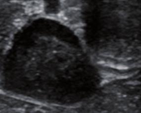 Konventionelle Ultraschallbilder eines Schilddrüsentumors. CEUS-Bilder eines Schilddrüsentumors.