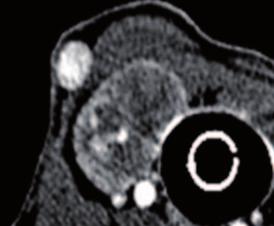 Zur Vorbereitung einer Tumoroperation an der Schilddrüse eignen sich die schärferen und detailreicheren computertomographischen Aufnahmen besser als Ultraschall oder CEUS.