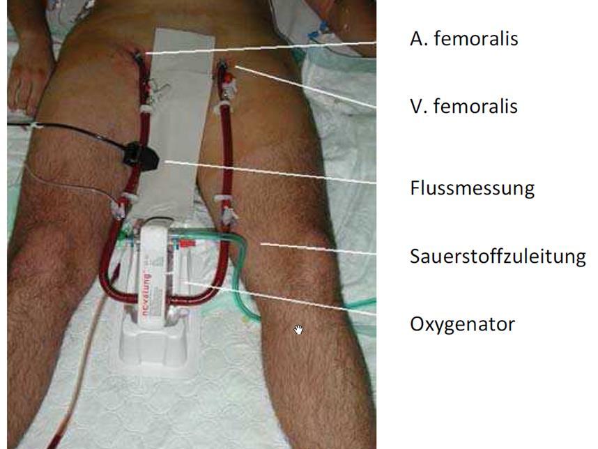 ECMO PECLA