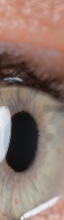WAS BEDEUTET DAS ÄLTERWERDEN FÜR DIE LINSE? Die Linse stellt einen wesentlichen Teil des Abbildungssystems des Auges dar (siehe Ausklappseite). In der Jugend ist sie klar und verformbar.