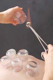 Schröpf-Massage Schröpfen ist eine traditionelle Behandlungsmethode. Dabei wird in so genannten Schröpfgläsern oder Schröpfköpfen ein Unterdruck erzeugt.
