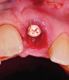 Auch in diesem Fall wurde die Wurzel des Zahns 21 knochenschonend minimalinvasiv entfernt, die bukkale Knochenwand