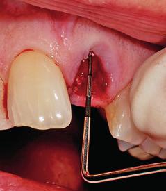 Nach der Extraktion wurde zur Vorbereitung der Implantation eine Kavität für ein Implantat (ZERAMEX XT, Dentalpoint)