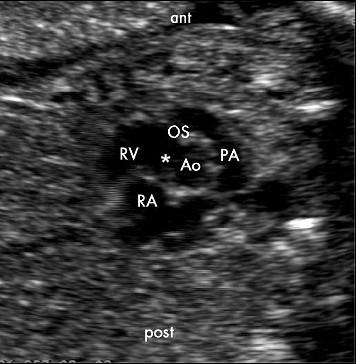 sind Geschwindigkeiten von 1-1,2 m/s über dem RVOT mit der Diagnose einer TOF vereinbar. Abbildung 4: Echokardiographie - kurze Herzachse auf Höhe der Aortenklappe, bei einem Feten mit TOF in der 21.