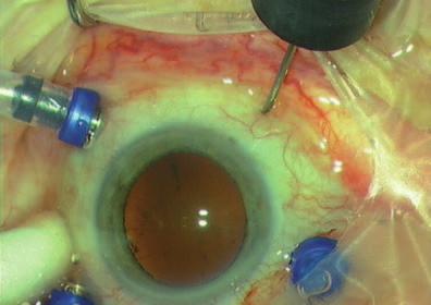 Amotio-Operation Amotio-Operation Die Operation einer Amotio retinae mit multiplen Foramina ist eine Operation für Fortgeschrittene, weil ein beträchtliches