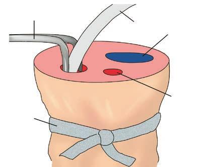 Schneiden Sie die Nabelschnur an der Basis tangential zum Abdomen durch und entfernen Sie eventuell geronnenes Blut, das die Blutgefäße verstopfen könnte. 3.