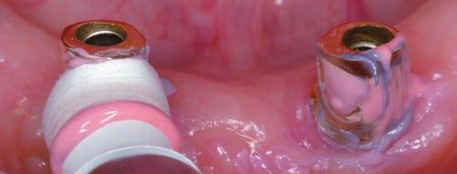 NachsoRGE tics Professionelle Pflege Funktionalität und Ästhetik von Implantaten und der prothetischen Versorgung sowie die generelle Mundgesundheit langfristig zu erhalten, ist das Ziel der