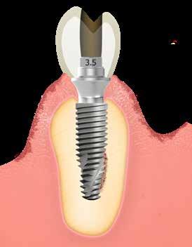 2.2 Retentionstyp: zementierte oder verschraubte Prothetik Implantatgetragene Prothetik kann je nach der klinischen Situation und der Präferenz des Zahnarztes entweder zementiert oder verschraubt