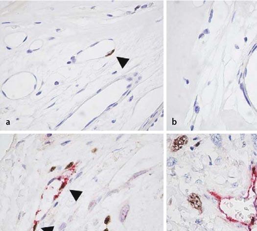 Doppelimmunhistochemie von-willebrand-faktor (braun)/glattmuskuläres Aktin (rot). (Mod. nach [12]) Expression von Angiogenesefaktoren in kartilaginären Tumoren Abb. 4 8 PCI in Knorpeltumoren.