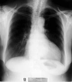 tion reduzierte sich bei Patienten mit fortgeschrittener systolischer Herzinsuffizienz und verbreitertem QRS-Komplex die v-welle des pulmonalkapillären Drucks (6), und die systolische