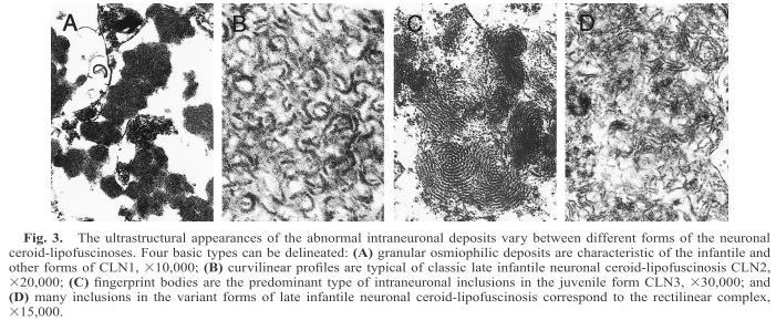 Abbildung 3-1: Kurvilineare Einschlusskörper typisch für CLN2 [11] Die Anreicherung des lysosomalen Speichermaterials in den Gehirnzellen, der Retina und dem zentralen Nervensystem führt zu der