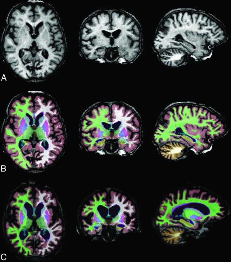 Baseline 3D-T1-weighted MPRAGE images in axial, coronal, and sagittal planes (left to right) of patient 457-1 (A), segmented brain volumes (B), and segmented brain volumes 4 years later (C).