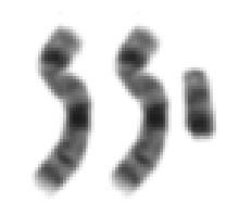 Chromsomenstörungen Die Erbinformation (DNA) liegt in menschlichen Zellen in Form vom 23 Chromosomenpaaren vor (46 Chromosomen insgesamt)