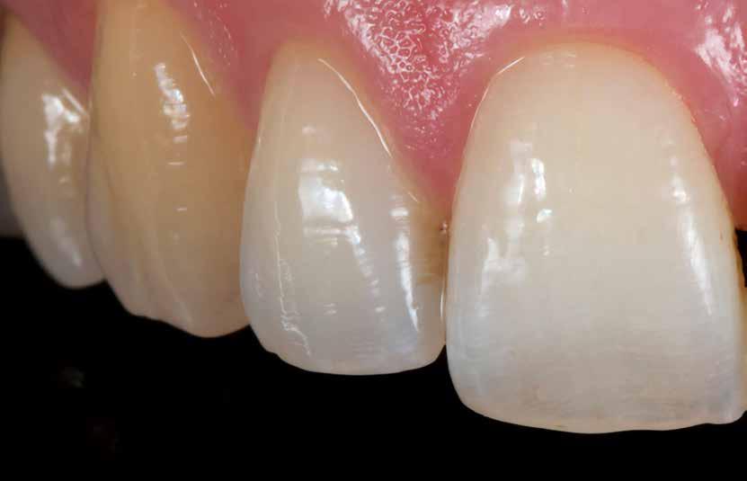 Sofortimplantation und Versorgung nach Verlust der Zähne 21 und 22 mit Hybridabutments (individuelles Zirkonoxid-Gerüst auf Titanklebebasis) WER ZIELE HAT, BRAUCHT MITTEL Ein Beitrag von Dr.