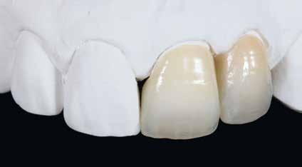 26a & b Bestimmung der Zahnfarbe.