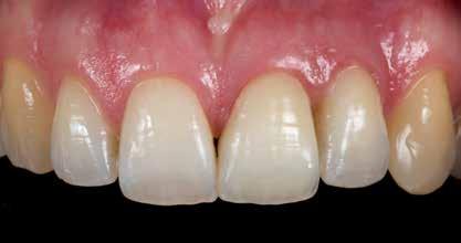 Die frakturierte mesiale Kante des Zahns 23 wurde von Dr.