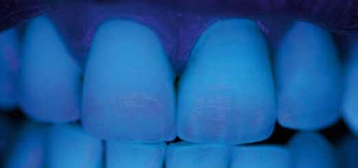 33 Die Fluoreszenz der Kronen in regio 21 und 22 entspricht der, der natürlichen Zähne.