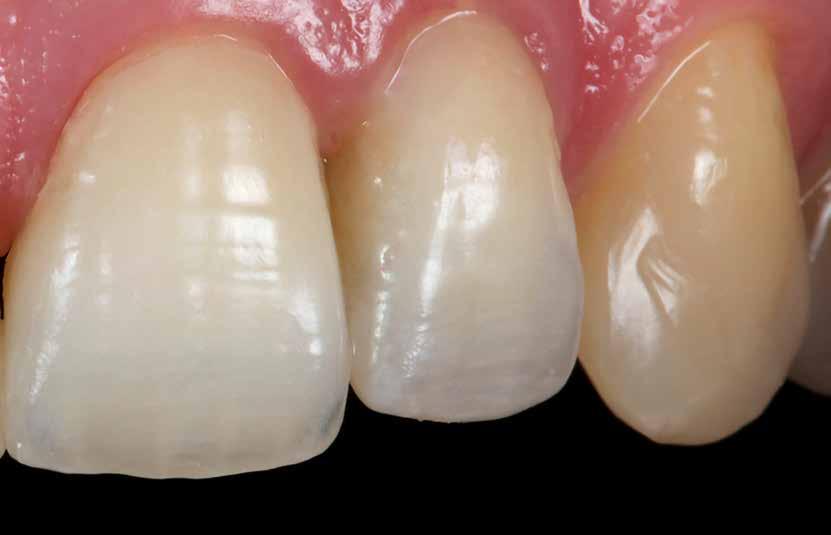Nach dem traumatischen Verlust eines Zahns stellt sich die Frage nach der Versorgung der Alveole. Vor allem in der ästhetischen Zone steht der bestmögliche Erhalt des Hart- und Weichgewebes im Fokus.