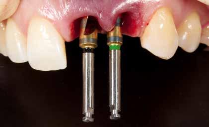 01a & b Nach einem Sturz: Querfraktur der Zähne 21 und 22 im Bereich der Wurzel 02 Die Alveolen vor der Sofortimplantation.