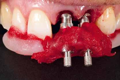 Im Sinne eines bestmöglichen Ergebnisses wurde entschieden, die frakturierten Zähne zu extrahieren. Zuvor wurde die Situation mit Alginat abgeformt. 2.