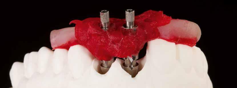 08 & 09 Die natürlichen Zahnkronen wurden in den Silikonwall (Duplierform des Situationsmodells) reponiert, die Form mit Gips ausgegossen und so ein Echtzahnmodell hergestellt 10 Die