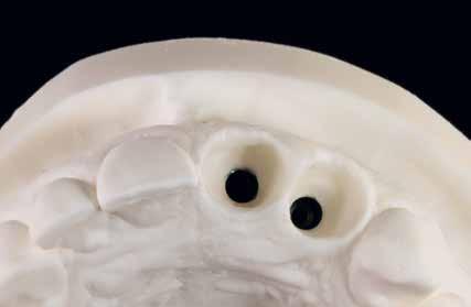 11 Implantatmodell: Das Emergenzprofil entspricht der Vorgabe der natürlichen, frakturierten Zahnkronen 12 Für die Digitalisierung des Modells wurden Scanpfosten eingesetzt hier mit dem ersten
