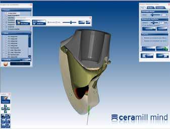 Die CAD-Software erkennt anhand der Scanpfosten, wo sich die Implantatschulter respektive die dreidimensional positionierten Implantate befinden.