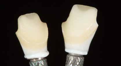 14a Die individuellen Zirkonoxid-Abutments (Weißlinge) entsprechen der Anatomie der natürlichen Zähne 14b Die Zirkonoxid-Abutments wurden im ungesinterten Zustand im labialen und marginalen Bereich