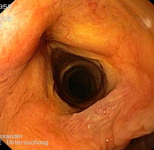 ATYPISCHE REFLUXKRANKHEIT DIAGNOSTIK Gastroenterologische Endoskopie