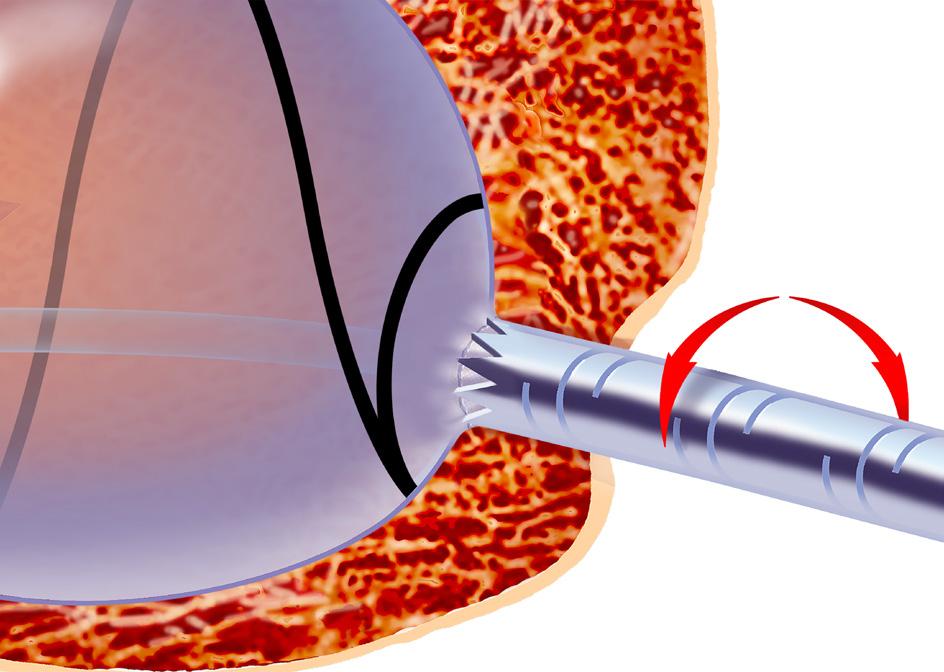 24. Bestätigen des Kontakts zwischen Stabilisator und Implantat Die eingekerbte Spitze des Stabilisators muss das proximale Ende des Implantats direkt berühren.