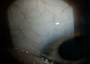 Beurteilung der Kontaktlinse Objektive