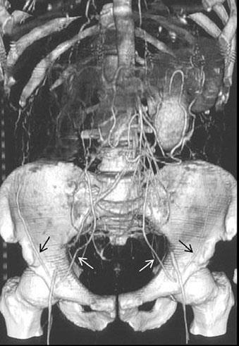 epigastric arteries (white arrows) allows recanalisation of the common femoral