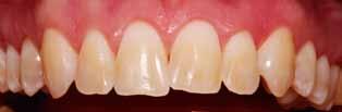 Nach einer zweiten Infiltration wurde die Kavitation mesial an Zahn 21 mit