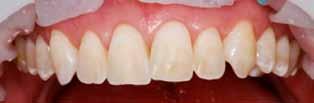 2g, h: Schattierungen auf der Zahnoberfläche, die sich zwischen den Farben Vita